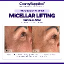 Micellar Lifting Before & After3rd try.webp